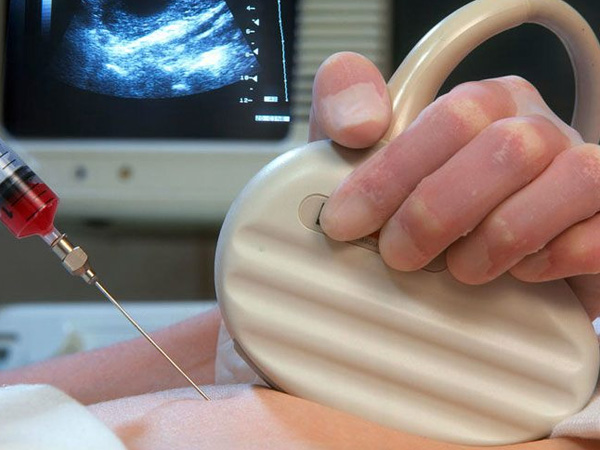 Mẹ bầu 4 tháng chọc ối xét nghiệm ADN nhận kết quả choáng váng: Thai nhi là con bố, không phải con mẹ