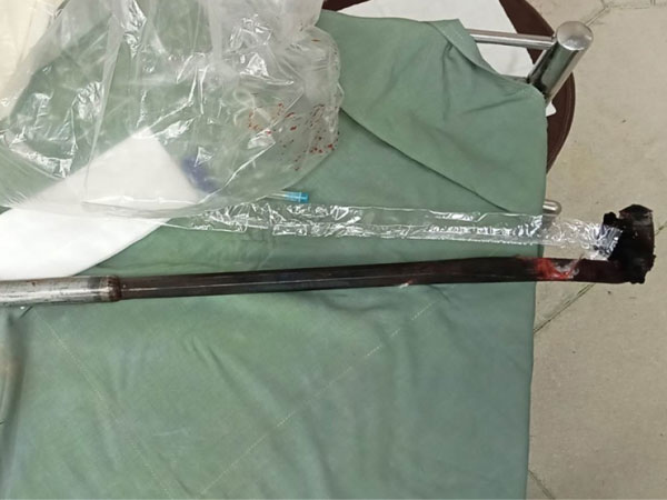 Cùng mẹ đi cạo mủ cao su, bé trai 12 tuổi bị dao cạo đâm xuyên bụng
