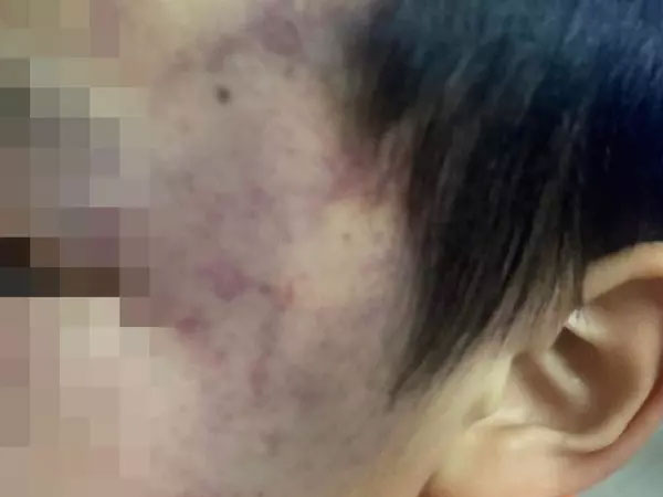 Xôn xao bé trai 4 tuổi bị con cô giáo cầm gậy đánh tím đen người