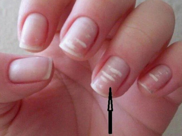 Móng tay, chân thêm đốm, sọc trắng, cảnh báo bệnh gì?