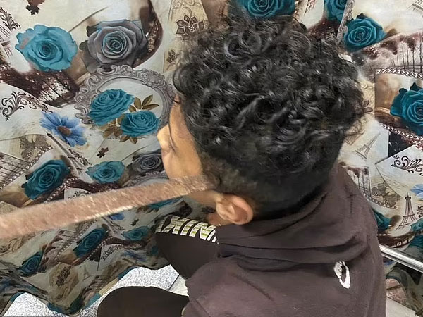 Bé trai bị bạn cùng lớp dùng đũa cả đâm xuyên hộp sọ
