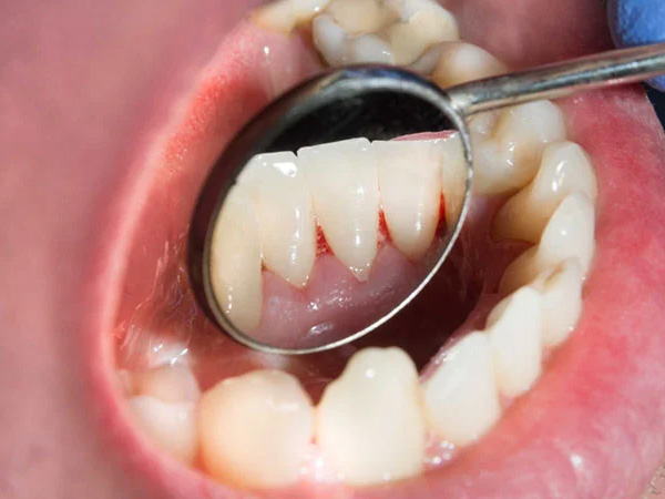 Chảy máu chân răng – Dấu hiệu cảnh báo nhiều bệnh nguy hiểm