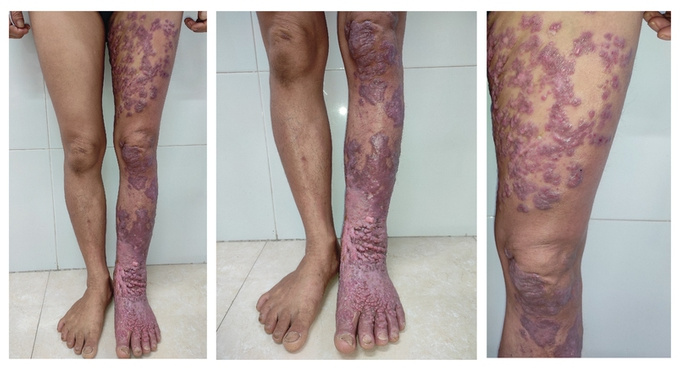 Nhiễm loại nấm da 'bị lãng quên', chân người phụ nữ sần sùi như vỏ cây