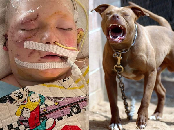 Bé trai 11 tuổi bị chó Pit Bull cắn rách 70% da đầu