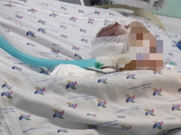 Bé 6 tháng tuổi phù não nguy kịch, nghi bị bạo hành ở nhà trẻ