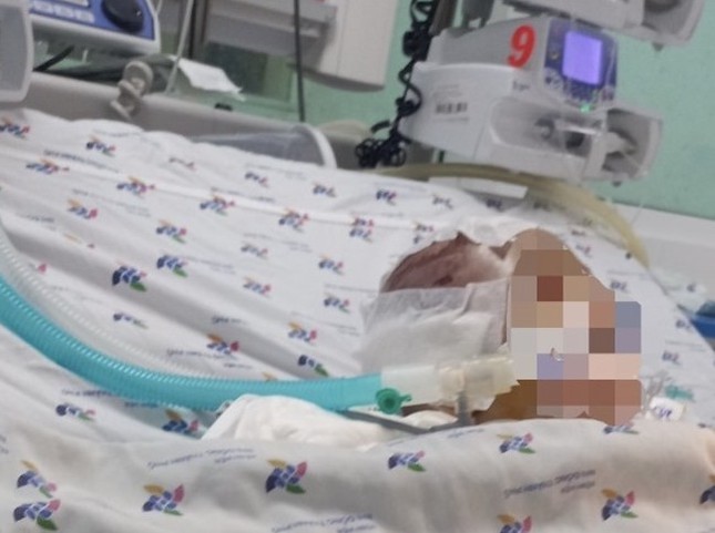 Vụ bé 6 tháng tuổi bị đánh dập não: Nạn nhân thương tích 99%