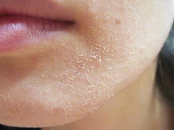 Cẩn trọng với tình trạng da bong tróc, nhiễm trùng khi về Bắc