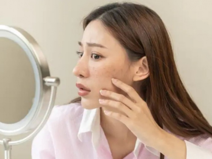 Biện pháp làm mờ sẹo mụn tại nhà để có làn da căng mọng đón Tết
