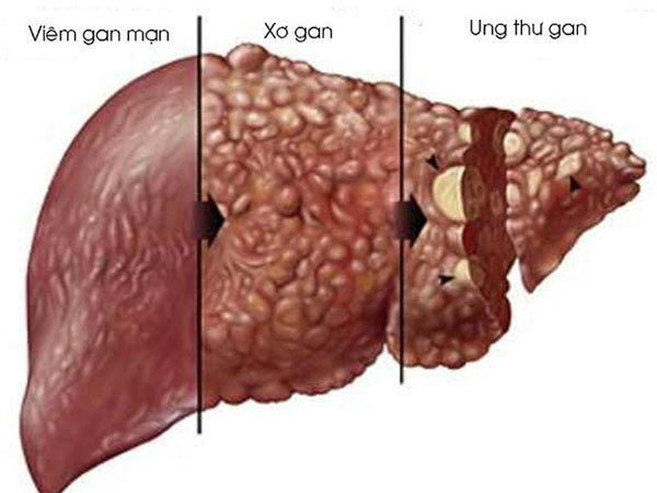 Bác sĩ đưa 'bí kíp' bảo vệ lá gan ngày Tết