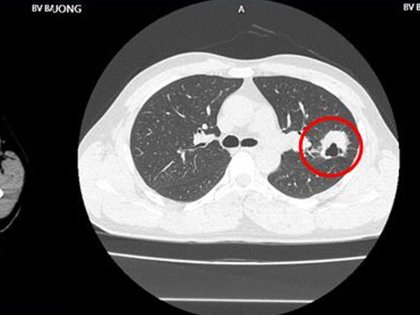 Có 2 dấu hiệu này đi khám, người đàn ông phát hiện ung thư di căn