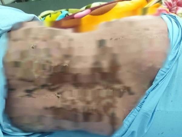 Suýt mất mạng vì dùng thuốc nam không rõ nguồn gốc chữa đau khớp
