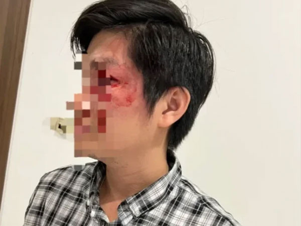 Người cha bị chủ chó đánh ở sảnh chung cư: Sức khỏe dần ổn định nhưng quyết không hòa giải