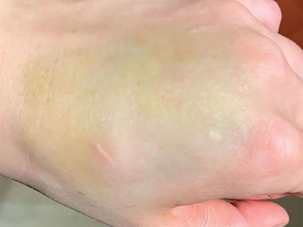 Vết bầm tưởng vô hại trên tay là dấu hiệu ung thư
