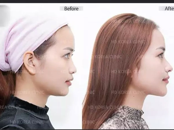 Từng nói 'thời gian đâu phẫu thuật', Hoa hậu Ngọc Châu bất ngờ lộ ảnh sửa toàn bộ khiến netizen tranh cãi dữ dội