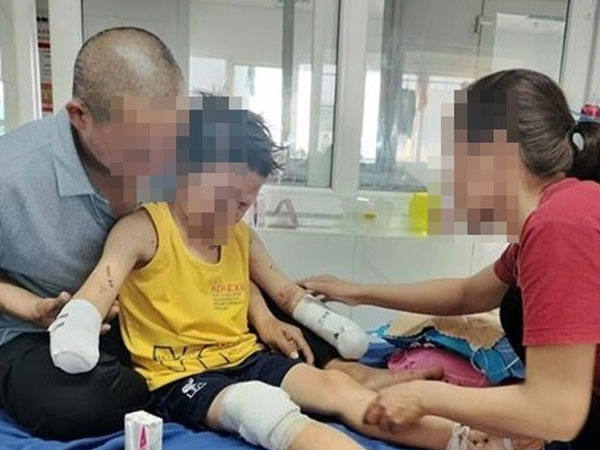 Vụ nghi nổ pháo tự chế ở Đắk Lắk: Bé trai bị đứt lìa hai bàn tay, khóc liên tục 20 tiếng/ngày