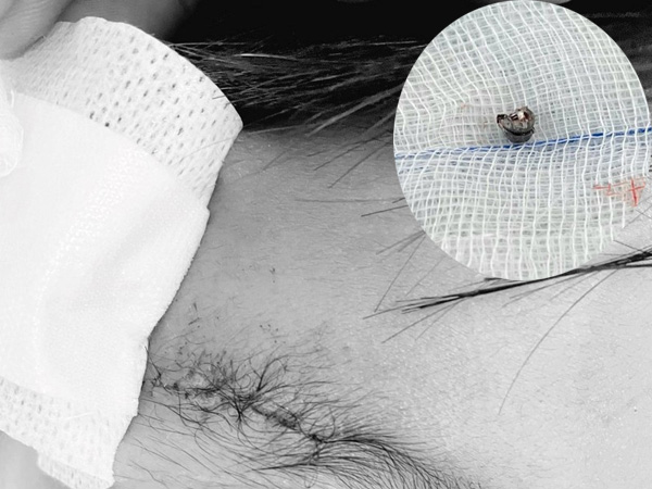 Nghịch súng hơi, bé trai 10 tuổi bị đạn chì găm vào xương sọ