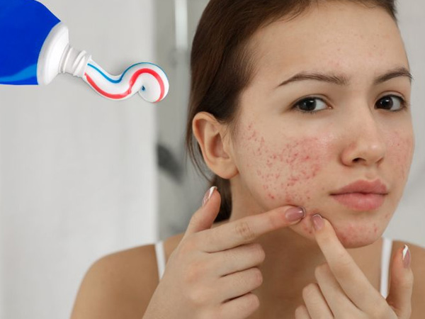 Bắt trend Tiktok 'dùng kem đánh răng trị mụn', mặt nữ sinh 20 tuổi 'nở hoa' phải cầu cứu bác sĩ