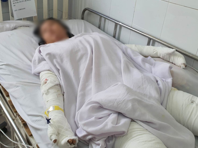Cha mẹ bỏng nặng, con gái tử vong vì nướng mực bằng cồn sát khuẩn