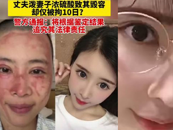 Tạt axit vào mặt vợ vì người phụ nữ đòi ly hôn, chồng chỉ bị tuyên 10 ngày giam giữ và hơn 1 triệu tiền phạt