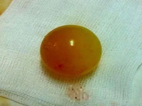 Bé gái 13 tháng tuổi phải nhập viện mổ khẩn cấp vì nuốt món đồ quen thuộc