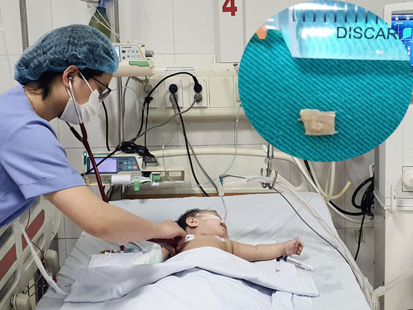 Bé gái 10 tháng tuổi suy hô hấp, phải thở máy vì hóc mía