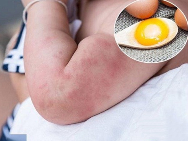 Dấu hiệu dị ứng trứng gà, ngưng ăn ngay kẻo sốc phản vệ gây mất ý thức
