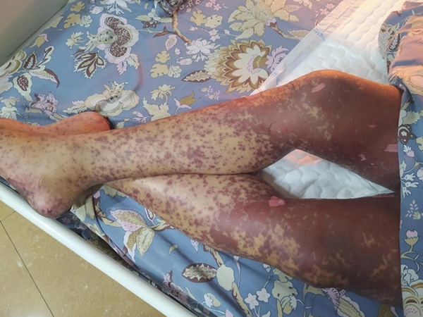 Người đàn ông suýt chết vì tự uống thuốc chữa đau rát họng