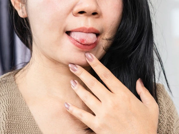 Người phụ nữ phát hiện ung thư nhờ bất thường ở lưỡi