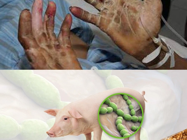 Bộ Y tế ra công văn 'nóng' cảnh báo về căn bệnh nguy hiểm lây từ lợn sang người