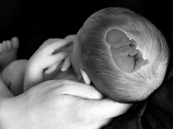 Phát hiện bào thai đang phát triển trong hộp sọ một bé gái