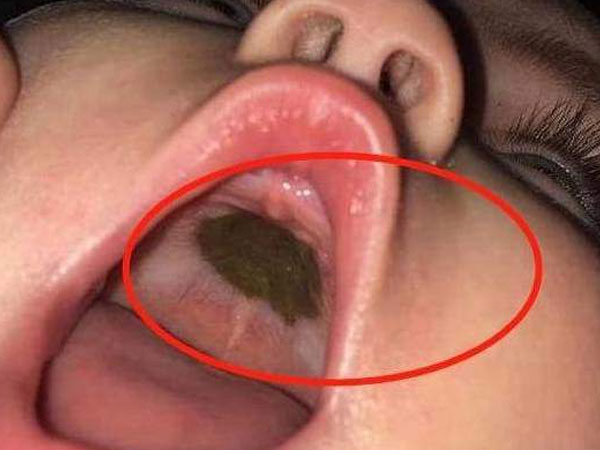 Phát hiện đốm đen kỳ lạ trong miệng con, mẹ lập tức đi khám, bác sĩ nói: Thật đáng mừng!