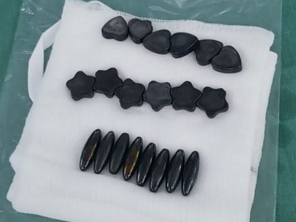 Nuốt 20 viên nam châm vì tưởng kẹo, bé trai phải cắt bỏ một đoạn ruột