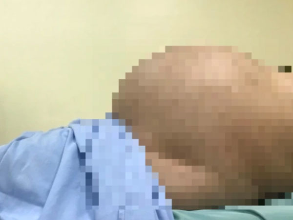 Tưởng béo bụng, không ngờ mang khối u gần 10kg