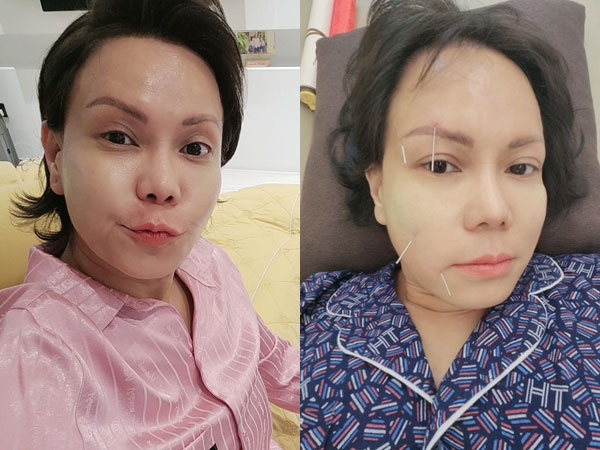 Việt Hương bị méo mặt, toàn thân phủ kín bởi 50 cây kim châm cứu