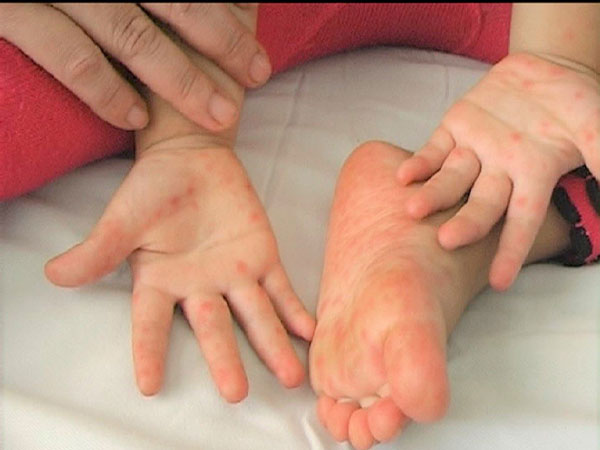 Nhiều trẻ Hà Nội trở nặng vì bệnh tay chân miệng, 3 dấu hiệu cần nhập viện ngay