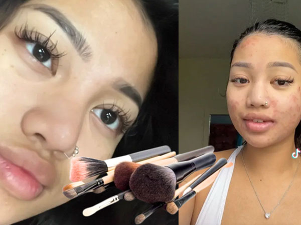 Cô gái 22 tuổi nhiễm giun đũa khắp mặt do dùng chung cọ trang điểm