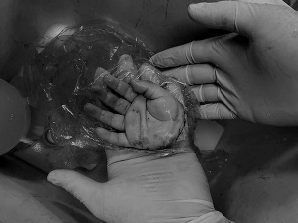 Báo động đỏ nối bàn tay đứt lìa cho bé trai 21 tháng tuổi