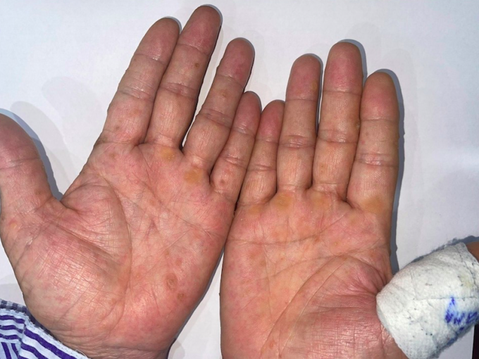Phát hiện ung thư từ dấu hiệu lạ ở bàn tay