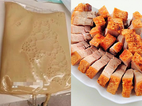 Suýt mất mạng vì ăn thịt heo quay, người phụ nữ máu vàng như mỡ