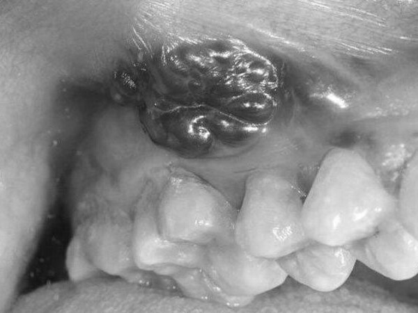 Từ ổ loét miệng, 6 tháng sau thành ung thư giai đoạn muộn