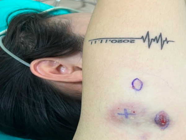 Nổi u cục khắp người sau khi tiêm tan mỡ giảm béo ở 'spa người quen'