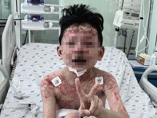 Bé trai 8 tuổi lở loét khắp người, nguy kịch sau 2 ngày ăn cua