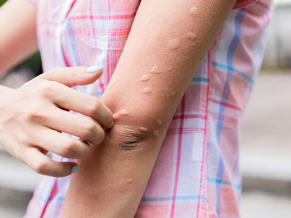 Nổi mề đay mẩm ngứa vào mùa hè phải làm sao?