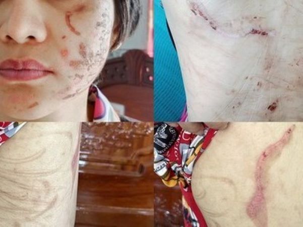 Thai phụ bị chồng bạo hành dã man như thời trung cổ kể lại quá trình trốn chạy về quê mẹ