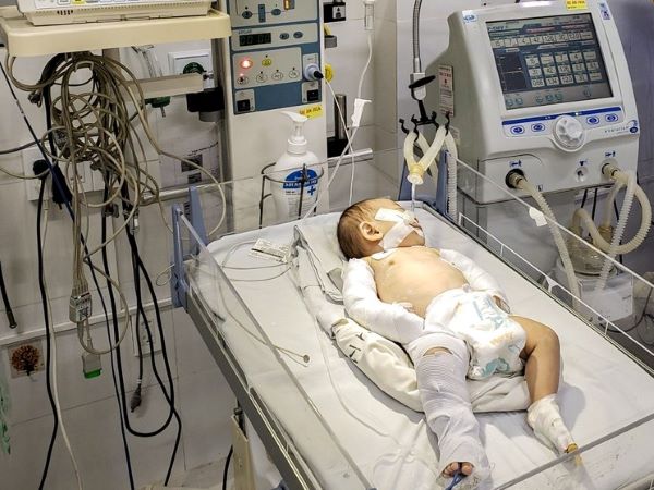 Bé gái 3 tháng tuổi bị bạo hành gãy tay chân, chấn thương sọ não