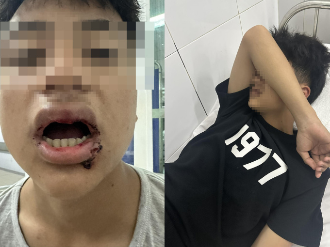Nam sinh ở Đà Nẵng bị nhóm thanh niên đánh gãy 4 răng, nhấn xuống biển
