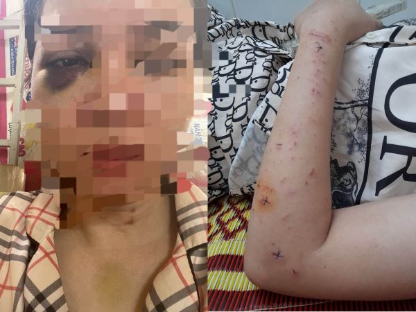 Xót xa người phụ nữ trẻ bị chồng cũ đánh nhập viện khi đến đón con: 'Tau đánh tan nát khuôn mặt mày luôn, cho mày hết sinh nhật'