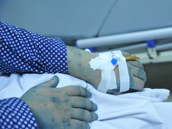 Lây thủy đậu từ con trai, ông bố trẻ ở Hải Dương tử vong khi mới 32 tuổi
