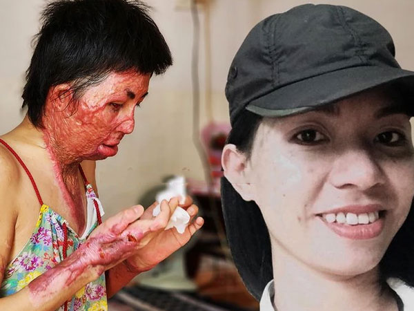 Bi kịch người phụ nữ bị chồng thiêu sống: Đau đớn đến mức ước chết, được tiếng hát của con 'cứu sống'