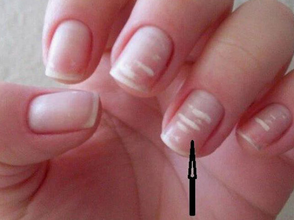 Đốm trắng trên móng tay cảnh báo bệnh gì, khi nào thì nguy hiểm?
